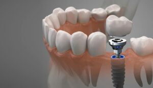 Имплантация зубов - современные подходы