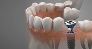 Имплантация зубов - современные подходы